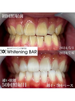 ホワイトニングバー 町田店/通い放題ビフォーアフター