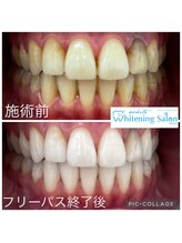 ホワイトニングサロン 四日市white/神経のない歯があっても大丈夫★