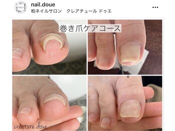 巻爪ケアお客様経過写真