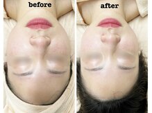 KMB 恵比寿店/毛穴洗浄＋光＋炭酸ガスパック