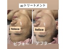 フェリーチェ(felice)の雰囲気（【acトリートメント】凍結乾燥人幹細胞培養液高速ジェット）