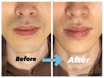 セレ(Cele)/ヒゲ脱毛で肌荒れも改善!