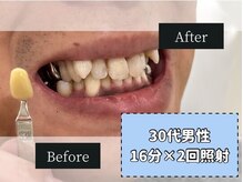 ホワイトニングカフェ 綾瀬店(WhiteningCafe)/◎歯のホワイトニング施術写真◎