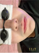 ミヤビ 竹ノ塚店(MIYA美)/メンズおひげ脱毛ー◎