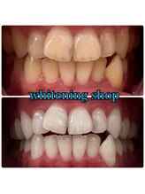 ホワイトニングショップ 明石大久保店/【BeforeAfter】