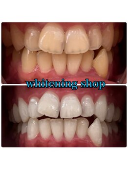 ホワイトニングショップ 明石大久保店/【BeforeAfter】