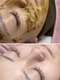 アイクイーン 亀戸(EyeQueen)の写真/《話題の水光ピール》つるんと透明感あふれる「うるツヤ肌」が目指せる大人気ケア!くすみのない美白肌へ♪