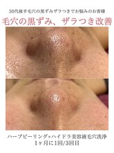 GRACETHOUSAND(グレイスサウザンド)/ハイドラ毛穴洗浄/毛穴の黒ずみ