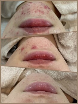 リサプリ(Re: Supple)/赤み・ポツポツにお悩みの方へ。