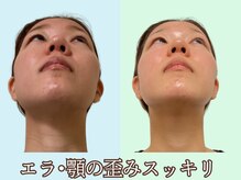 ナチュラルパーフェクトフェイス 新宿/エラ、顎の歪みは新宿小顔専門店