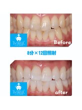 ティンクルホワイト 上尾店/ホワイトニングビフォーアフター