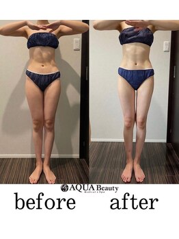 ビーエスアクアビューティー/太もも痩身12回コース
