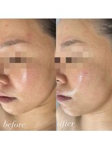 ビューティーサロン プティ(beauty salon petite)/毛穴・ハーブ・ポレーション