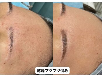 リメイク 銀座(REMAKE)/★幹細胞導入１Day肌メニュー