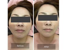 ラクシュミー/小顔◆ビフォーアフター