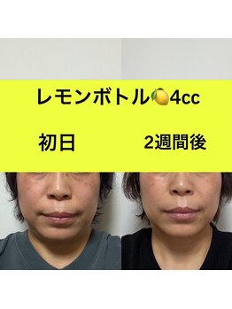 L’la citta【パーソナルカラー/毛穴洗浄/まつげパーマ/ヘッドスパ】/レモンボトル4cc