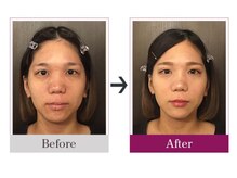 ビコツゼロ 青山(BIKOTSU ZERO)/小顔・むくみ