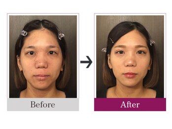 ビコツゼロ 青山(BIKOTSU ZERO)/小顔・むくみ