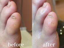 ドクターネイル爪革命 札幌本店/症例紹介１９　たこ・うおのめ