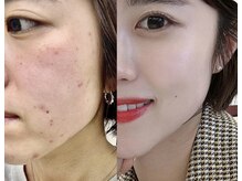 エミニナル(EMININAL)/【フェイシャル】変化