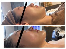 ビノスビューティー(vinos.beauty)/症例写真　小顔矯正/小倉エステ