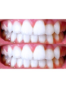 毛穴ケアをしたい