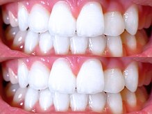 ホワイヤ セルフホワイトニング DBS神楽坂(Whi-Ya)