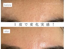 ウェヌ(VENE)/フェイシャルワックス＋泥パック