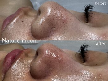 ナチュールムーン(Nature moon.)/毛穴洗浄