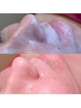 フィール(FEEL)/毛穴洗浄&REVIハーブピーリング