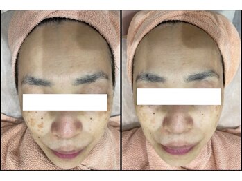 リッツ 大宮店/【Before/After】シミ改善