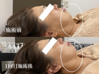 キーオブフェイス(Key of Face)/お悩み【あごと首】