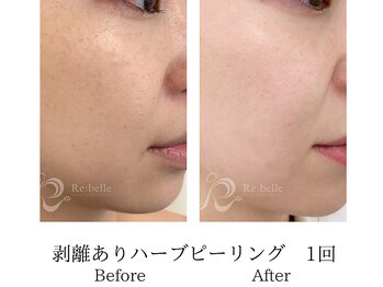 ミーシェ(Meshie)/ハーブピーリング