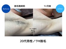 メンズアメリ/高知/メンズ脱毛/ヒゲ/全身/VIO