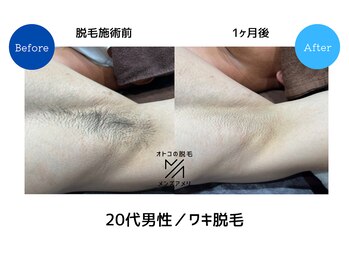 メンズアメリ/高知/メンズ脱毛/ヒゲ/全身/VIO