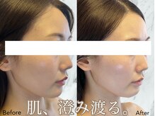 ルミライ(Lumirai)/たるみ改善|毛穴|フェイシャル