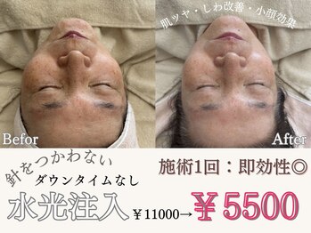 マヴィ 香里園店(MavY.)/ノンニードル水光注入☆