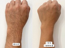 セルフメイド 東大阪店(SELFMADE)/腕を脱毛して清潔感アップ♪