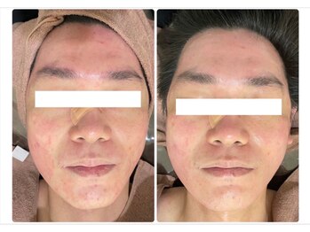 ホワイトアクア つくば店(WHITE AQUA)/ハーブピーリング/毛穴ケア/常総