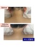 夏お得【キッズ全身脱毛(VIO/顔込)10歳～15歳限定】痛みが少ない全身美肌脱毛