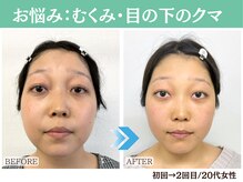 ナチュラルビューティーフェイス 横浜(NBF)/むくみ・目の下のクマ / 20代