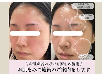 ミュー 豊田店(mieux)/お肌が敏感な方も施術可能