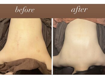 雅菜(miyabina)/美背中ケア！子供のようなお肌へ