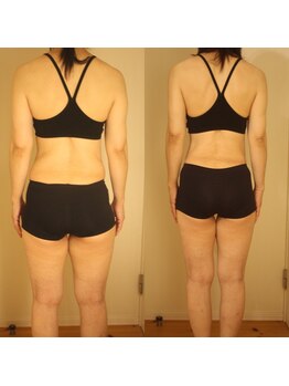 クライオ360(Cryo360)/脂肪冷却ビフォーアフター