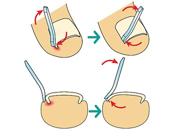 牛久巻き爪センター/スマートリフト法は