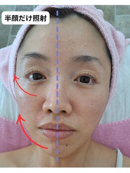 リアウェイク(Reawayke)の写真/ラジオ波でたるみを引き上げる技術が魅力！ほうれい線を目立たなくするケアを♪
