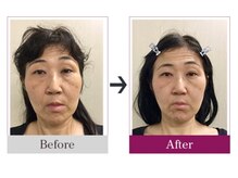 ビコツゼロ 青山(BIKOTSU ZERO)/小顔・フェイスラインの左右差