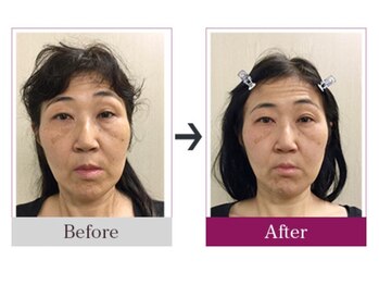 ビコツゼロ 青山(BIKOTSU ZERO)/小顔・フェイスラインの左右差