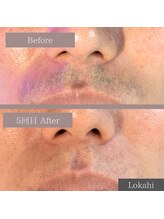 ロカヒ(Lokahi)/脱毛ビフォーアフター