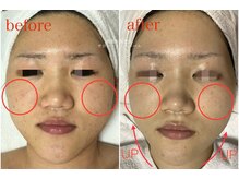 サロン ド ラポール/毛穴ケア3ヶ月　before→after